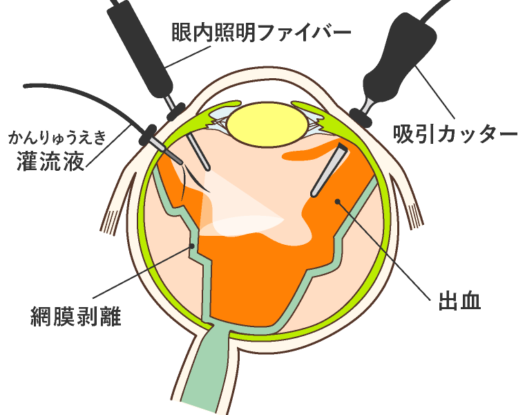 硝子体手術